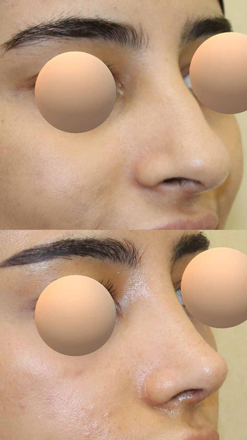 Rhinoplasty · case three — Right oblique